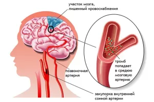 Инсульт-восстановление